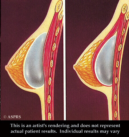 Breast Augmentation Illustration 3