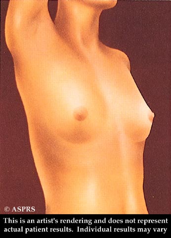 Breast Augmentation Illustration 1