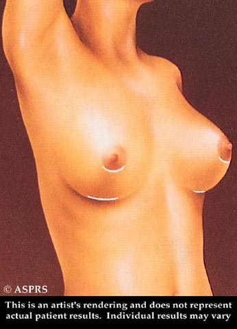 Breast Augmentation Illustration 4
