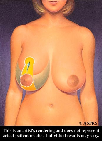 Breast Reduction Illustration 2