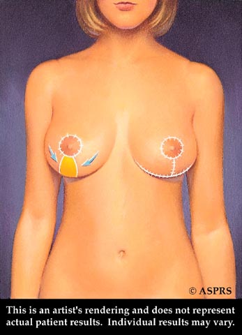 Breast Reduction Illustration 3