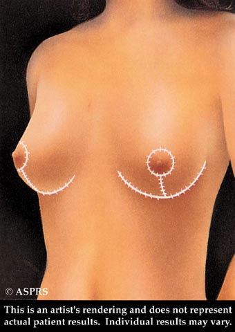 Breast Lift Illustration 4