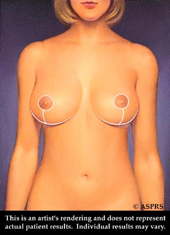 Breast Reduction Illustration 4