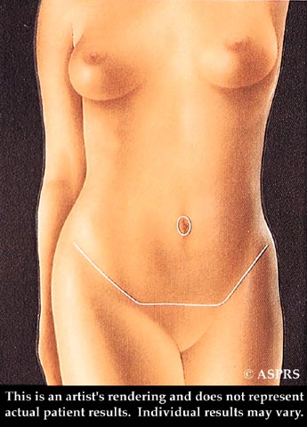 Tummy Tuck Illustration 5