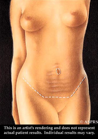 Tummy Tuck Illustration 1