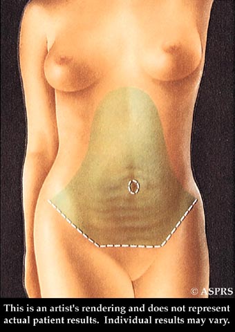 Tummy Tuck Illustration 2