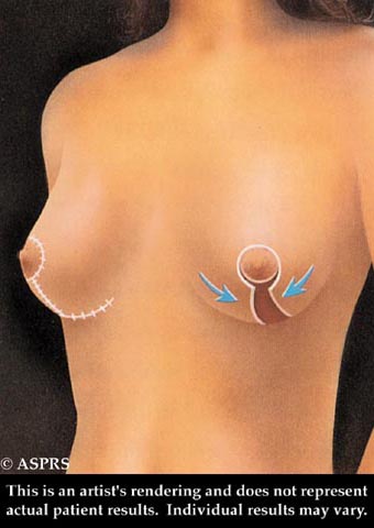 Breast Lift Illustration 3