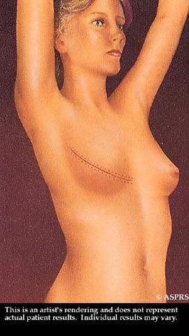 Breast Reduction Illustration 3