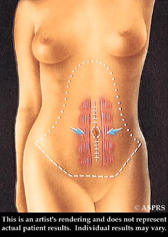 Tummy Tuck - Abdominoplasty, Huntsville, AL