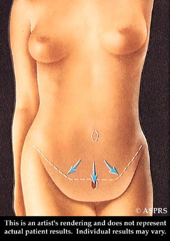 ▷ Belly Button Infected After Tummy Tuck: Understanding and Managing