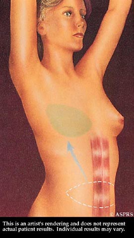 Breast Reduction Illustration 6