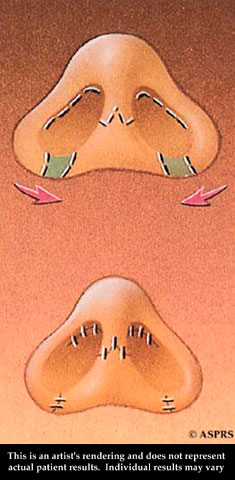 Nose Surgery Illustration 5